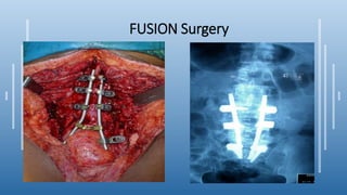 FUSION Surgery
 