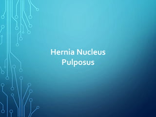 Hernia Nucleus
Pulposus
 
