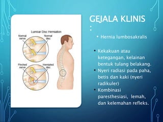 GEJALA KLINIS
:
• Hernia lumbosakralis
• Kekakuan atau
ketegangan, kelainan
bentuk tulang belakang.
• Nyeri radiasi pada paha,
betis dan kaki (nyeri
radikuler)
• Kombinasi
paresthesiasi, lemah,
dan kelemahan refleks.
 