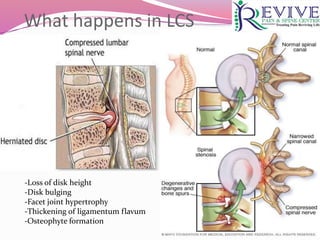 What happens in LCS
-Loss of disk height
-Disk bulging
-Facet joint hypertrophy
-Thickening of ligamentum flavum
-Osteophyte formation
 