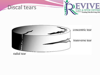 Discal tears
 