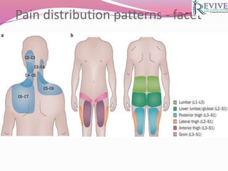 Pain distribution patterns - facet
 