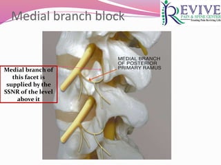Medial branch block
Medial branch of
this facet is
supplied by the
SSNR of the level
above it
 