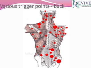 Various trigger points - back
 