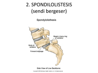2. SPONDILOLISTESIS
(sendi bergeser)
 