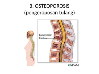 3. OSTEOPOROSIS
(pengeroposan tulang)
 