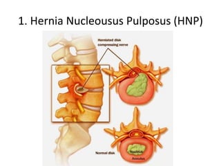 1. Hernia Nucleousus Pulposus (HNP)
 