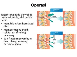Operasi
Tergantung pada penyebab
rasa sakit Anda, ahli bedah
dapat
• menghilangkan herniated
disc
• memperluas ruang di
sekitar saraf tulang
belakang
• dan / atau menyambung
dua tulang belakang
bersama-sama.
 