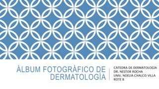 ÀLBUM FOTOGRÀFICO DE
DERMATOLOGÌA
CÀTEDRA DE DERMATOLOGÌA
DR. NESTOR ROCHA
UNIV. NOELIA CHALCO VILLA
ROTE B
 