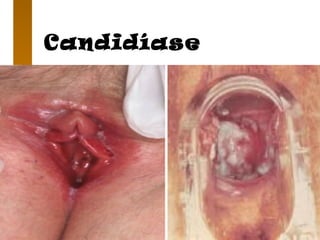 Candidíase
 