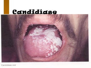 Candidíase
 