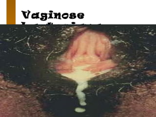 Vaginose
bacteriana
 