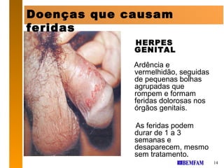 Doenças que causam
feridas
             HERPES
             GENITAL

             Ardência e
             vermelhidão, seguidas
             de pequenas bolhas
             agrupadas que
             rompem e formam
             feridas dolorosas nos
             órgãos genitais.

             As feridas podem
             durar de 1 a 3
             semanas e
             desaparecem, mesmo
             sem tratamento.
                                     14
 