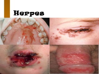 Herpes
 