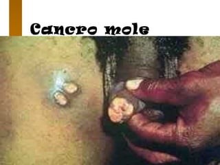 Cancro mole
 