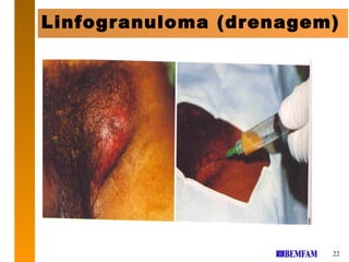 Linfogranuloma (drenagem)




                        22
 