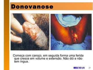 Donovanose




Começa com caroço, em seguida forma uma ferida
 que cresce em volume e extensão. Não dói e não
 tem íngua.
                                                  23
 