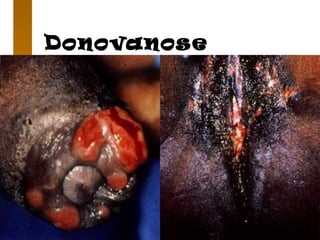 Donovanose
 