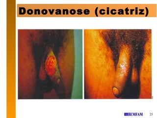 Donovanose (cicatriz)




                        25
 