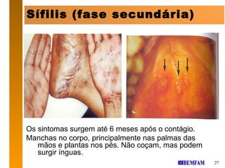 Sífilis (fase secundária)




Os sintomas surgem até 6 meses após o contágio.
Manchas no corpo, principalmente nas palmas das
   mãos e plantas nos pés. Não coçam, mas podem
   surgir ínguas.
                                                  27
 