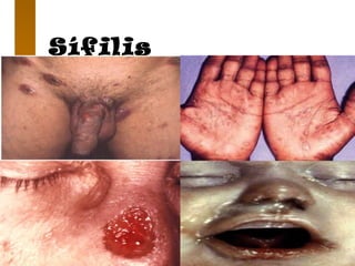 Sífilis
 
