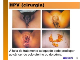 HPV (cirurgia)




A falta de tratamento adequado pode predispor
ao câncer do colo uterino ou do pênis.
                                                32
 