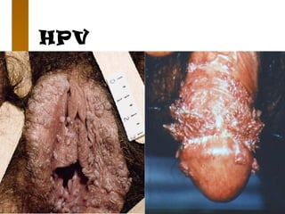 HPV
 