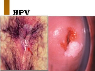 HPV
 