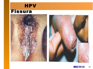 HPV
Fissura




          40
 