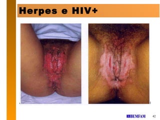 Herpes e HIV+




                42
 