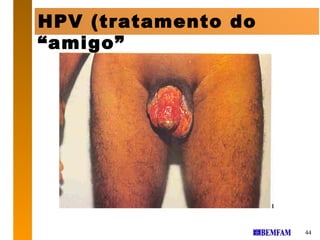 HPV (tratamento do
“amigo”




                     44
 