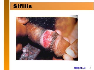 Sífilis




          45
 