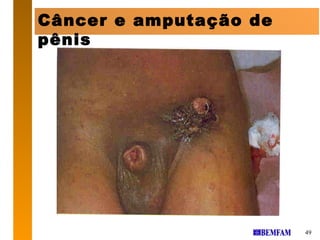 Câncer e amputação de
pênis




                        49
 