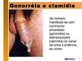 Gonorréia e clamídia

            No homem,
            manifesta-se com
            corrimento
            amarelado
            (gonorréia) ou
            esbranquiçado
            (clamídia) no canal
            da urina e ardência
            ao urinar.


                                  7
 