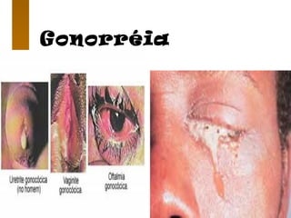 Gonorréia
 