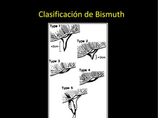 20/01/14
Clasificación de Bismuth
 