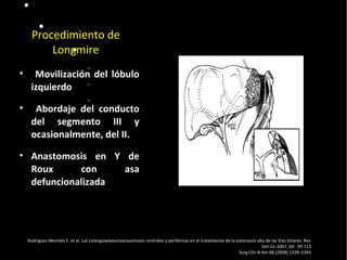  Pulse para editar los formatos del
texto del esquema
 Segundo nivel del esquema
− Tercer nivel del esquema
 Cuarto nivel del
esquema
− Quinto nivel
del esquema
− Sexto nivel
del esquema
− Séptimo
nivel del
esquema
− Octavo nivel
del esquema
Noveno nivel del esquemaHaga clic para
modificar el estilo de texto del
patrón
20/01/14
Procedimiento de
Longmire
• Movilización del lóbulo
izquierdo
• Abordaje del conducto
del segmento III y
ocasionalmente, del II.
• Anastomosis en Y de
Roux con asa
defuncionalizada
Rodriguez-Montalv F, et al. Las colangioyeyeunoanasomosis centrales y perifericas en el tratamiento de la estenossis alta de las Vias biliares. Rev
Ven Cir 2007; 60: 99-113
Surg Clin N Am 88 (2008) 1329–1343
 