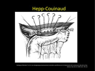 20/01/14
Hepp-Couinaud
Rodriguez-Montalv F, et al. Las colangioyeyeunoanasomosis centrales y perifericas en el tratamiento de la estenossis alta de las Vias
biliares. Rev Ven Cir 2007; 60: 99-113
 