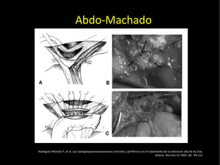 20/01/14
Abdo-Machado
Rodriguez-Montalv F, et al. Las colangioyeyeunoanasomosis centrales y perifericas en el tratamiento de la estenossis alta de las Vias
biliares. Rev Ven Cir 2007; 60: 99-113
 