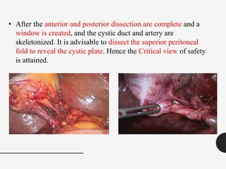 • After the anterior and posterior dissection are complete and a
window is created, and the cystic duct and artery are
skeletonized. It is advisable to dissect the superior peritoneal
fold to reveal the cystic plate. Hence the Critical view of safety
is attained.
 