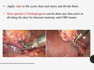 • Apply clips to the cystic duct and artery and divide them.
• Intra operative Cholangiogram can be done any time prior to
dividing the duct for aberrant anatomy and CBD stones
 