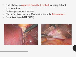 • Gall bladder is removed from the liver bed by using L-hook
electrocautery
• Before specimen extraction.
• Check the liver bed, and Cystic structures for haemostasis.
• Drain is optional (HRPOM)
 