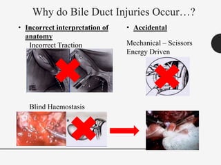 Why do Bile Duct Injuries Occur…?
• Incorrect interpretation of
anatomy
Incorrect Traction
Blind Haemostasis
• Accidental
Mechanical – Scissors
Energy Driven
 