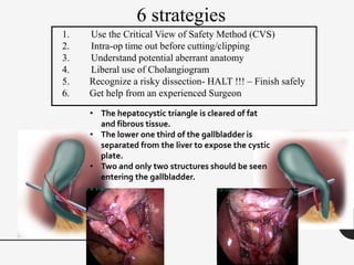 6 strategies
1. Use the Critical View of Safety Method (CVS)
2. Intra-op time out before cutting/clipping
3. Understand potential aberrant anatomy
4. Liberal use of Cholangiogram
5. Recognize a risky dissection- HALT !!! – Finish safely
6. Get help from an experienced Surgeon
• The hepatocystic triangle is cleared of fat
and fibrous tissue.
• The lower one third of the gallbladder is
separated from the liver to expose the cystic
plate.
• Two and only two structures should be seen
entering the gallbladder.
 