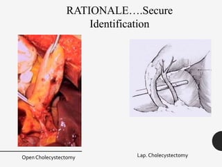 RATIONALE….Secure
Identification
Open Cholecystectomy Lap. Cholecystectomy
 