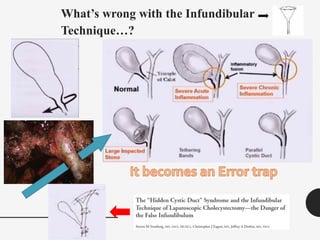What’s wrong with the Infundibular
Technique…?
 