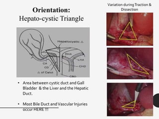 Orientation:
Hepato-cystic Triangle
• Area between cystic duct and Gall
Bladder & the Liver and the Hepatic
Duct.
• Most Bile Duct andVascular Injuries
occur HERE !!!
Variation duringTraction &
Dissection
 