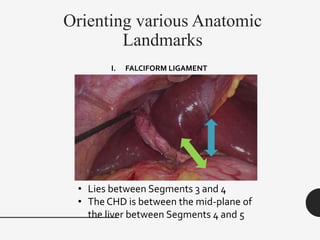 Orienting various Anatomic
Landmarks
I. FALCIFORM LIGAMENT
• Lies between Segments 3 and 4
• The CHD is between the mid-plane of
the liver between Segments 4 and 5
 