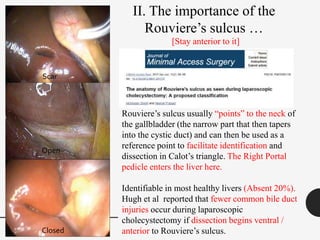 Rouviere’s sulcus usually “points” to the neck of
the gallbladder (the narrow part that then tapers
into the cystic duct) and can then be used as a
reference point to facilitate identification and
dissection in Calot’s triangle. The Right Portal
pedicle enters the liver here.
Identifiable in most healthy livers (Absent 20%).
Hugh et al reported that fewer common bile duct
injuries occur during laparoscopic
cholecystectomy if dissection begins ventral /
anterior to Rouviere’s sulcus.
Scar
Open
Closed
II. The importance of the
Rouviere’s sulcus …
[Stay anterior to it]
 