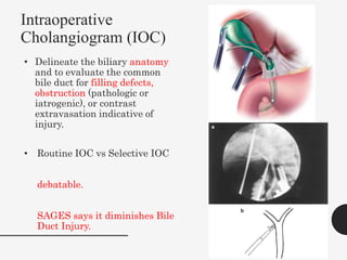 Intraoperative
Cholangiogram (IOC)
• Delineate the biliary anatomy
and to evaluate the common
bile duct for filling defects,
obstruction (pathologic or
iatrogenic), or contrast
extravasation indicative of
injury.
• Routine IOC vs Selective IOC
debatable.
SAGES says it diminishes Bile
Duct Injury.
 
